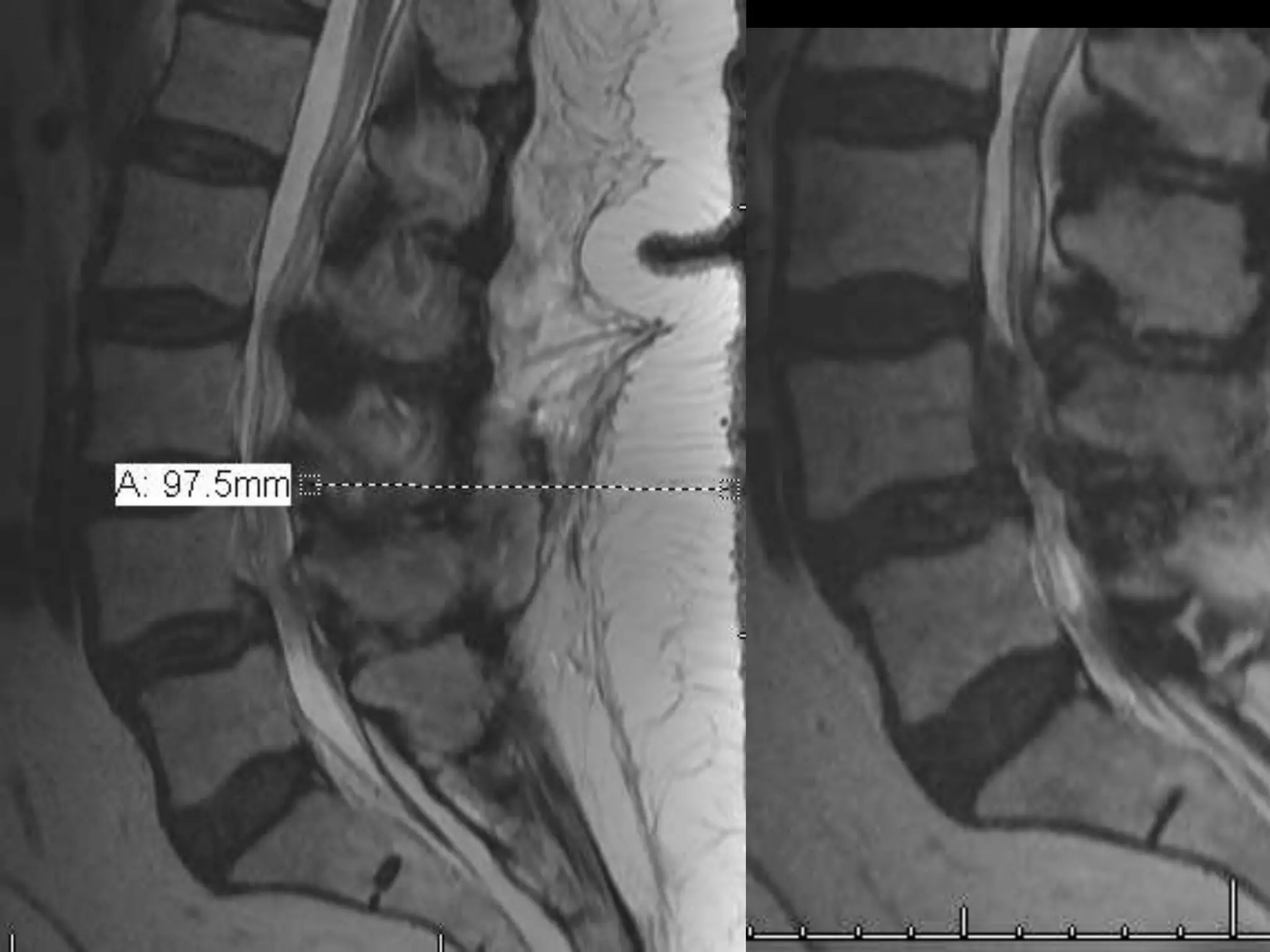 Preventing surgical site infections in spinal surgery | PPTX