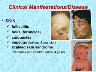 Clinical Manifestations/Disease
• SKIN
 folliculitis
 boils (furuncles)
 carbuncles
 impetigo (bullous & pustular)
 scalded skin syndrome
•Neonates and children under 4 years
 
