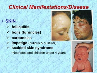 Clinical Manifestations/Disease
• SKIN
 folliculitis
 boils (furuncles)
 carbuncles
 impetigo (bullous & pustular)
 scalded skin syndrome
•Neonates and children under 4 years
 