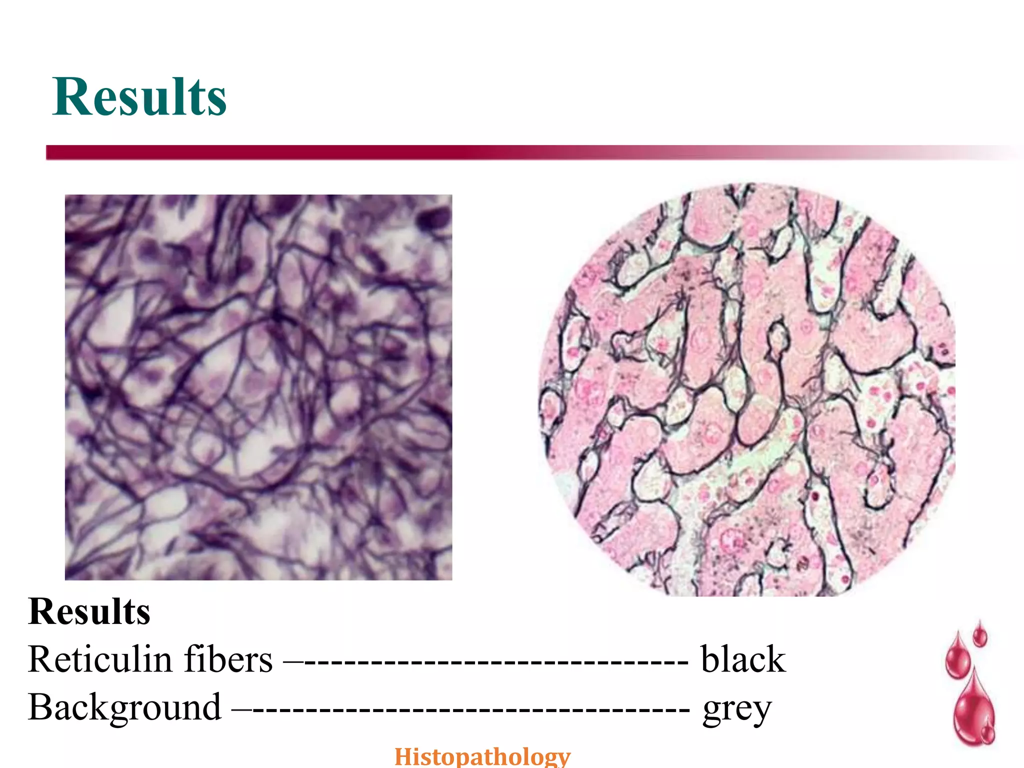Results
Results
Reticulin fibers –----------------------------- black
Background –--------------------------------- grey
Histopathology
 