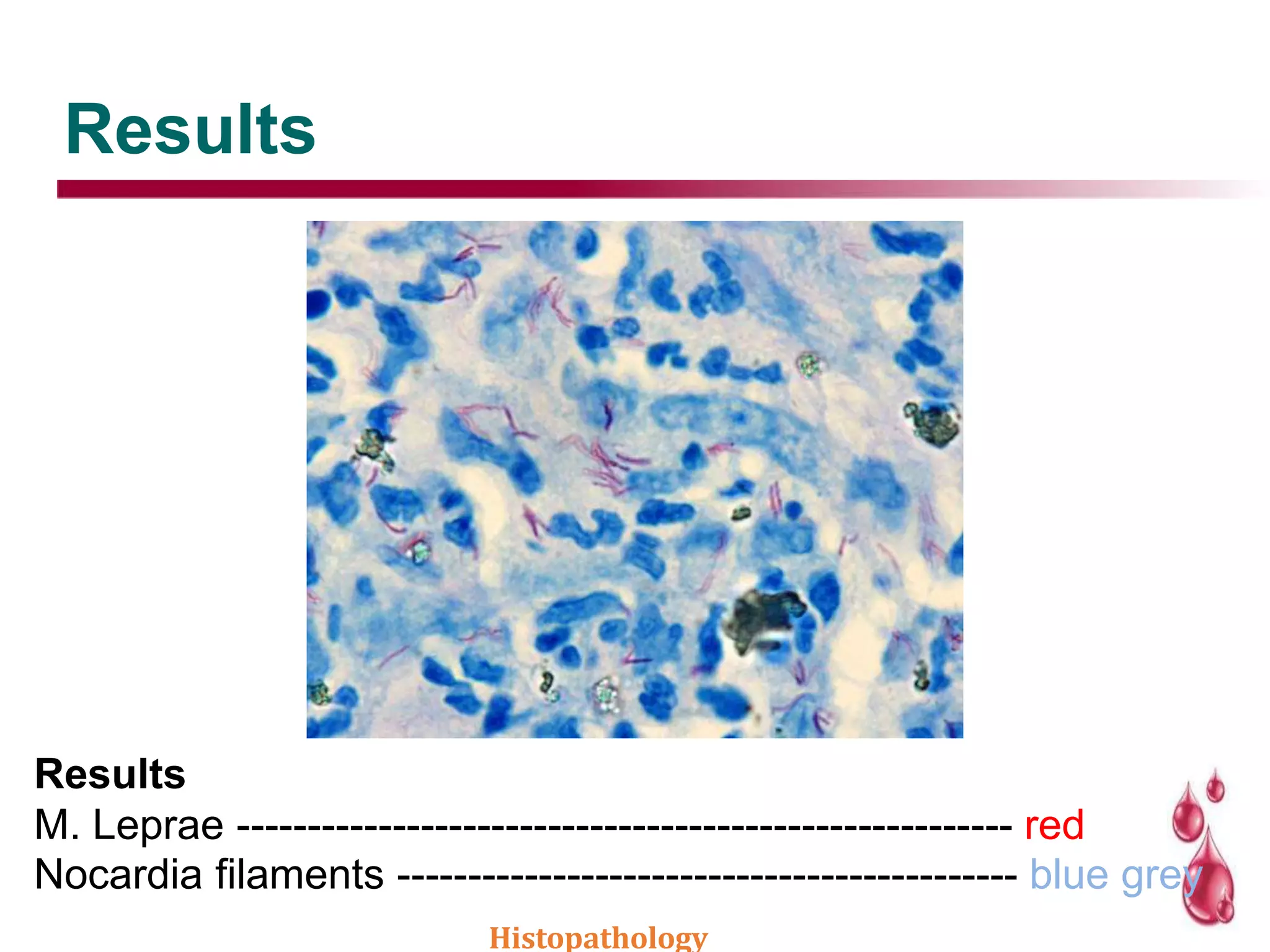 Results
Results
M. Leprae ------------------------------------------------------- red
Nocardia filaments -------------------------------------------- blue grey
Histopathology
 