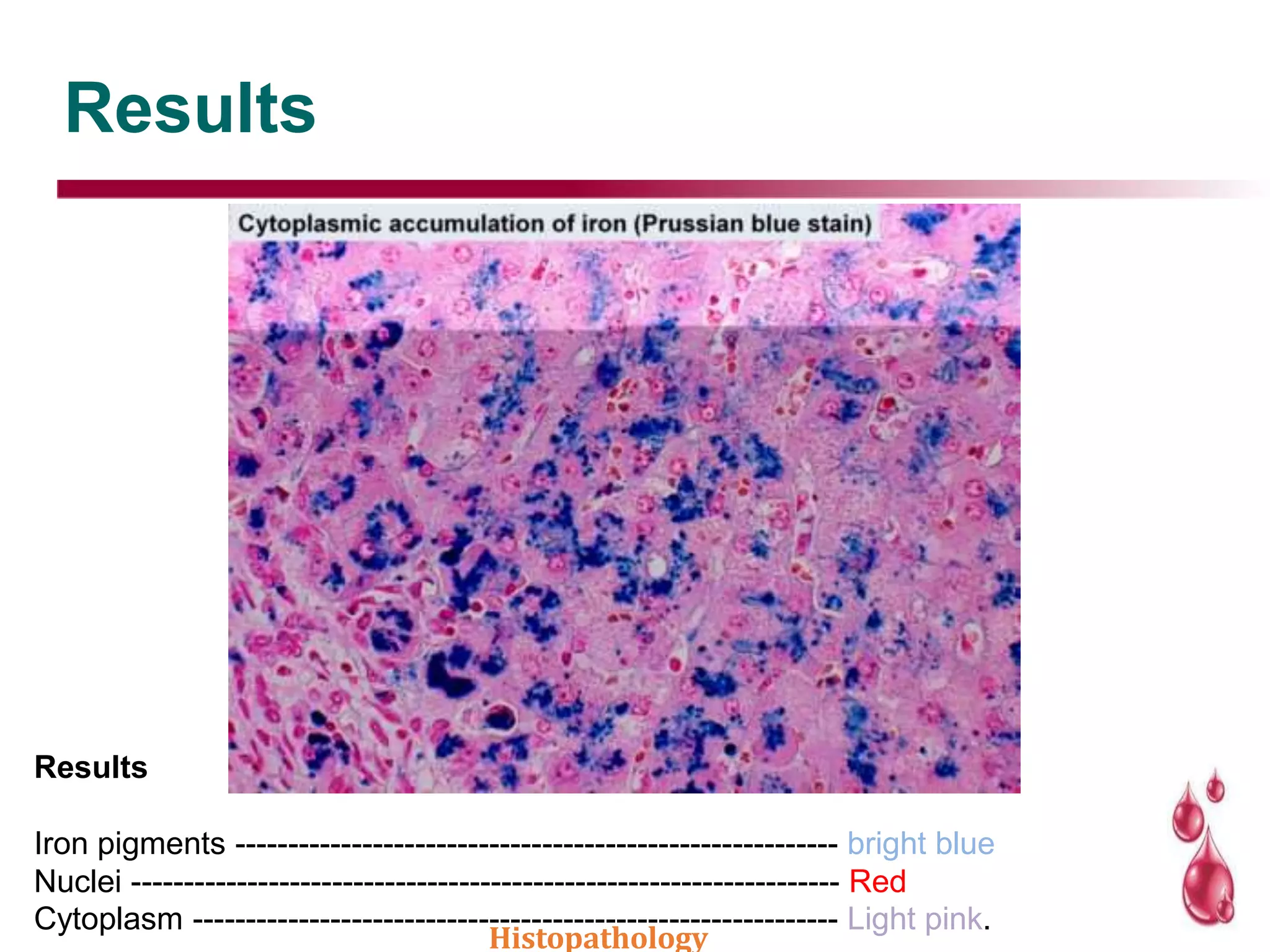Results
Results
Iron pigments --------------------------------------------------------- bright blue
Nuclei ------------------------------------------------------------------- Red
Cytoplasm ------------------------------------------------------------- Light pink.
Histopathology
 