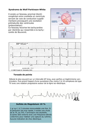 Syndrome de Wolf Parkinson-White

Il existe un faisceau anormal (Kent)
congénital entre oreillette et ventricule
servant de voie de conduction supplé-
mentaire provoquant une excitation
prématurée des ventricules
(préexcitation)
Ce faisceau favorise les tachycardies
par réentrée qui ressemble à la tachy-
cardie de Bouveret.




     Torsade de pointe

Débute le plus souvent sur un intervalle QT long, avec parfois un bigéminisme ven-
triculaire. Puis prend l’aspect d’une succession d’au moins 5 à 10 complexes de type
TV avec une rotation progressive autour de la ligne iso-électrique.




        Sulfate de Magnésium 10 %

 1 gr sur 1 à 2 minutes renouvelable une fois. Si
 la perfusion est trop rapide, il existe une chute
 de la TA, en IVD, il provoque une asystolie.
 Si échec EES externe avec une fréquence élevée
 (100/min) pour réaliser une capture du rythme.
 Aucune indication de choc électrique.
 