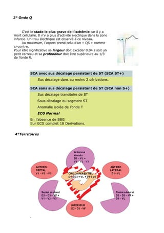 3° Onde Q



      C’est le stade le plus grave de l’ischémie car il y a
mort cellulaire. Il n’y a plus d’activité électrique dans la zone
infarcie. Un trou électrique est observé à ce niveau.
      Au maximum, l’aspect prend celui d’un « QS » comme
ci-contre.
Pour être significative sa largeur doit excéder 0.04 s soit un
petit carreau et sa profondeur doit être supérieure au 1/3
de l’onde R.




           SCA avec sus décalage persistant de ST (SCA ST+)
                Sus décalage dans au moins 2 dérivations.

           SCA sans sus décalage persistant de ST (SCA non S+)
                Sus décalage transitoire de ST
                Sous décalage du segment ST
                Anomalie isolée de l’onde T
                ECG Normal
           En l’absence de BBG
           Sur ECG complet 18 Dérivations.


4°Territoires
 