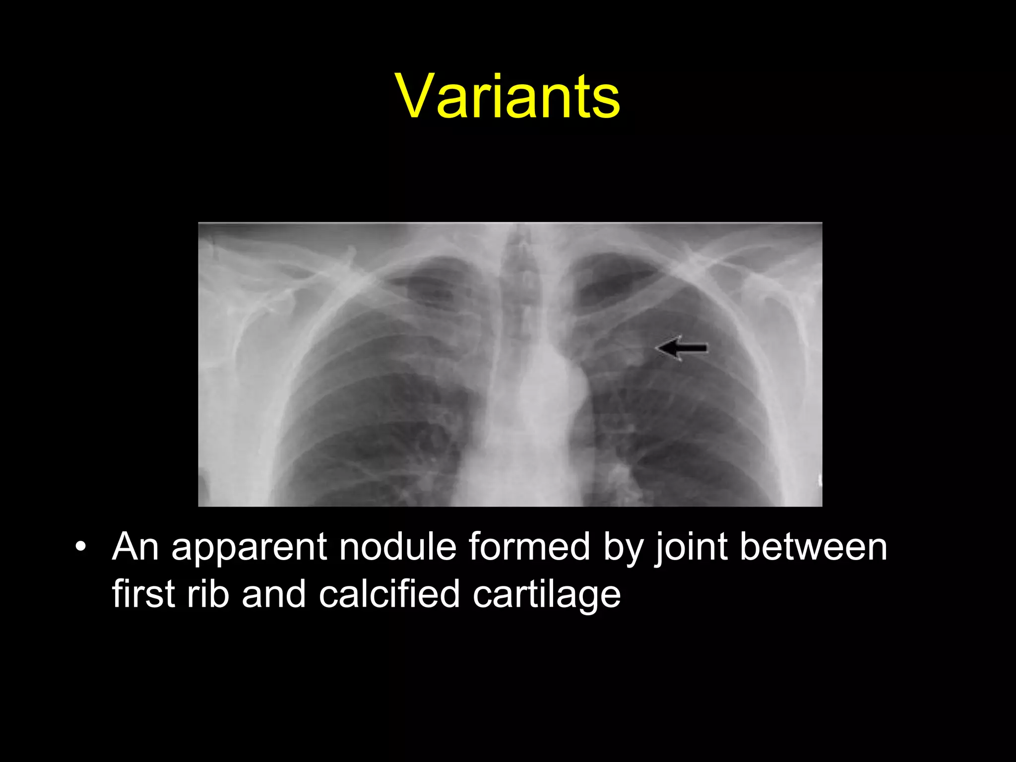 Variants
• An apparent nodule formed by joint between
first rib and calcified cartilage
 