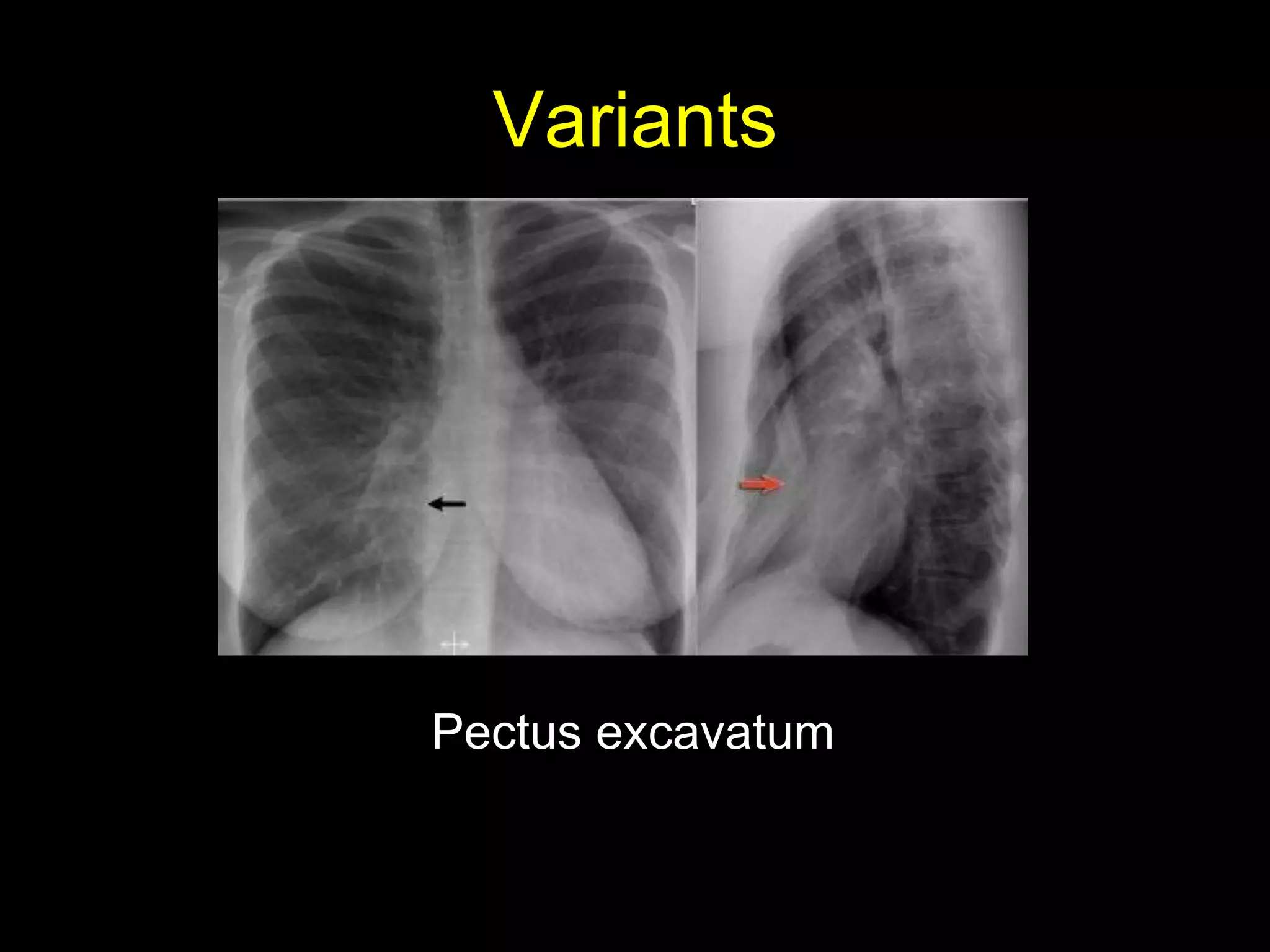 Variants
Pectus excavatum
 