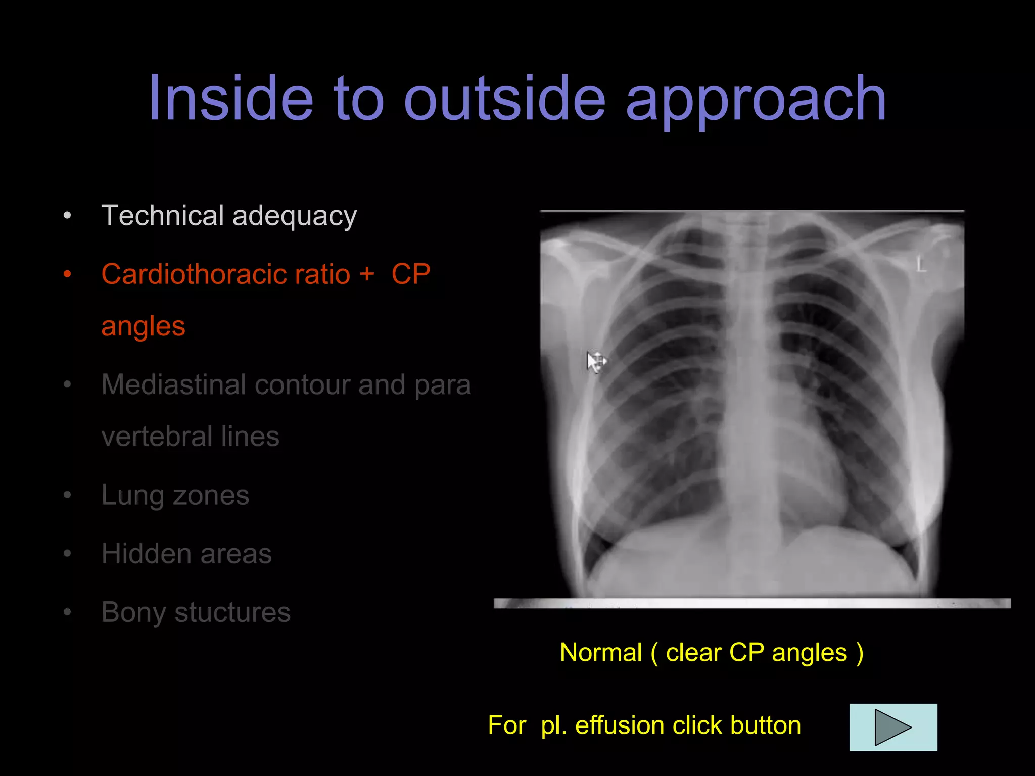 Inside to outside approach
• Technical adequacy
• Cardiothoracic ratio + CP
angles
• Mediastinal contour and para
vertebral lines
• Lung zones
• Hidden areas
• Bony stuctures
Normal ( clear CP angles )
For pl. effusion click button
 