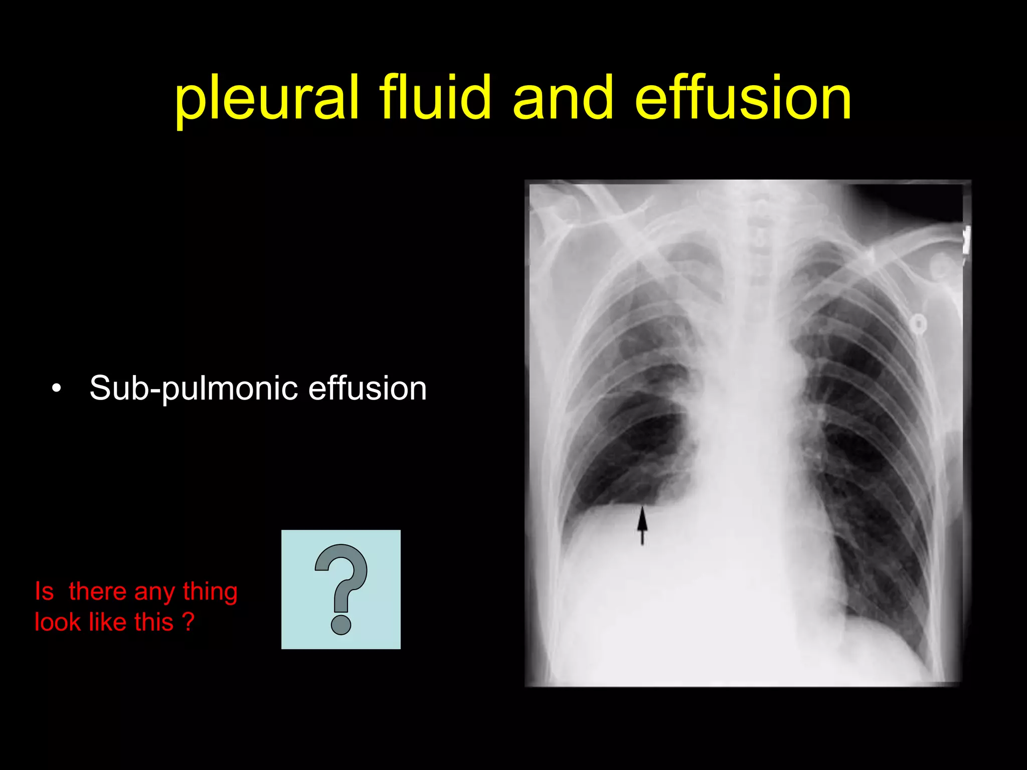 pleural fluid and effusion
• Sub-pulmonic effusion
Is there any thing
look like this ?
 