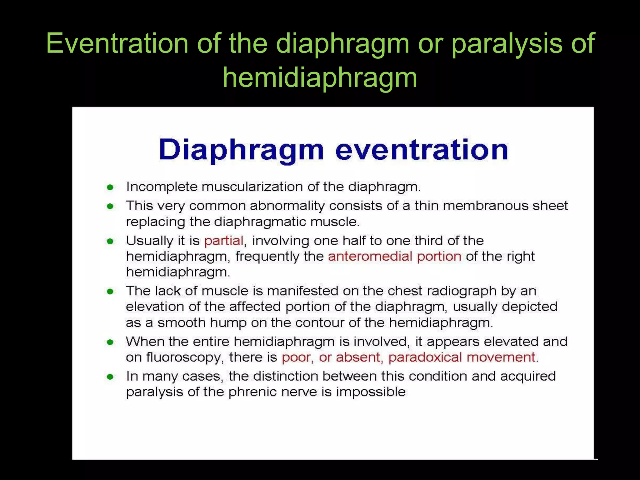 Eventration of the diaphragm or paralysis of
hemidiaphragm
 