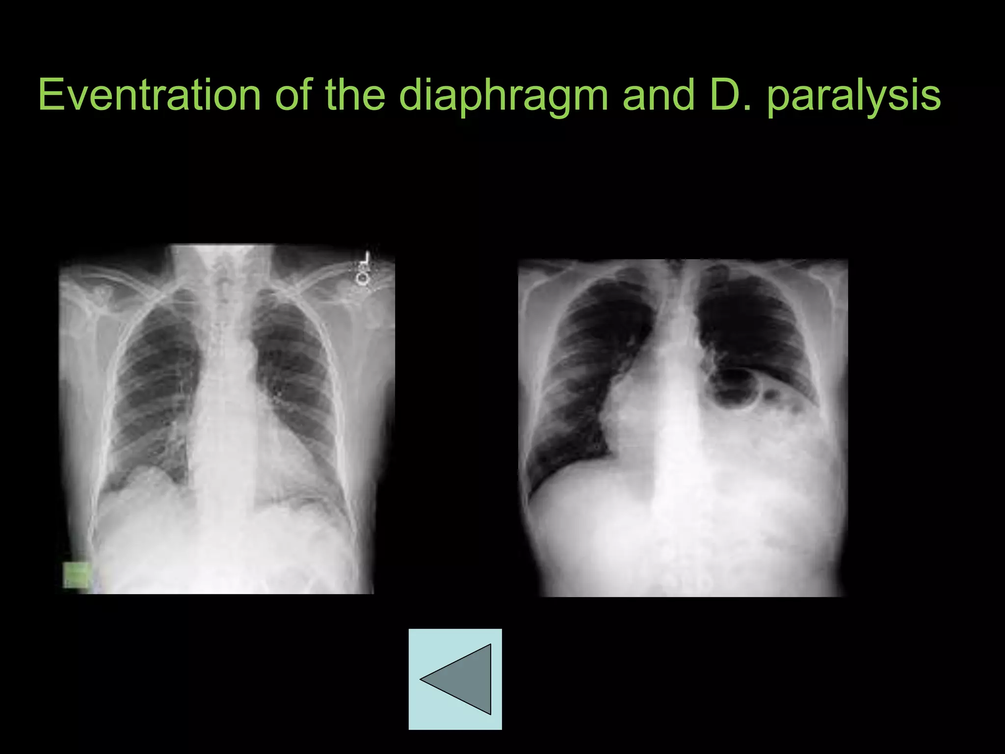 Eventration of the diaphragm and D. paralysis
 