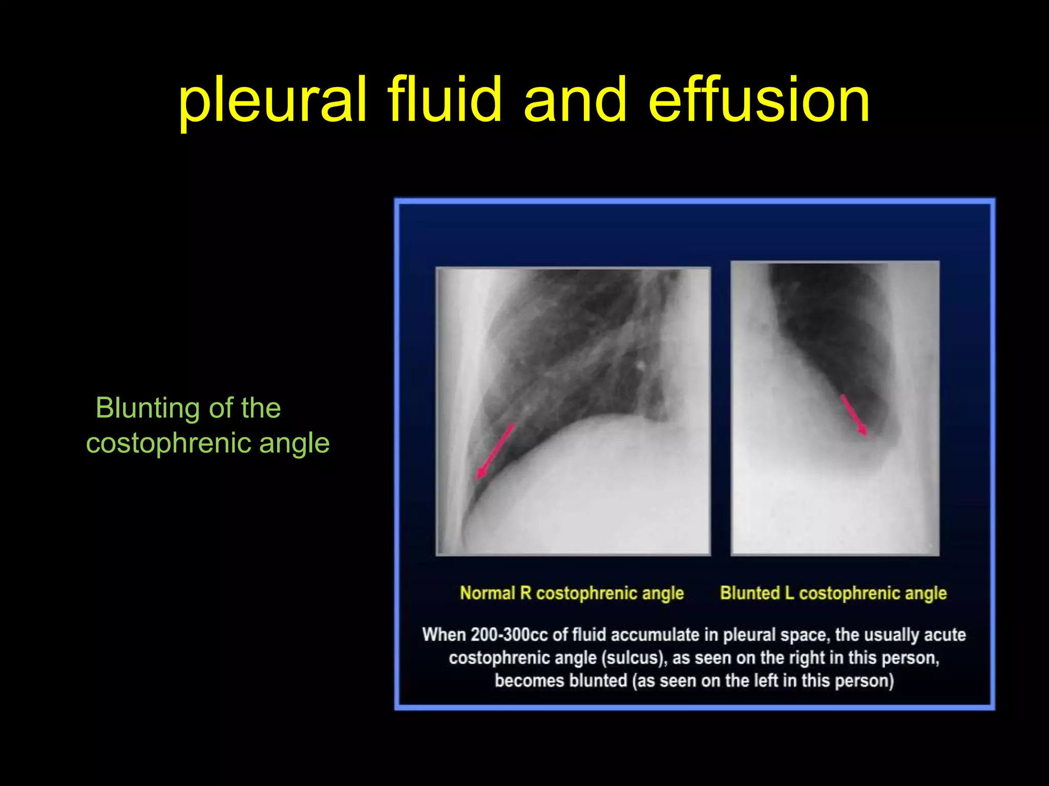 pleural fluid and effusion
Blunting of the
costophrenic angle
 