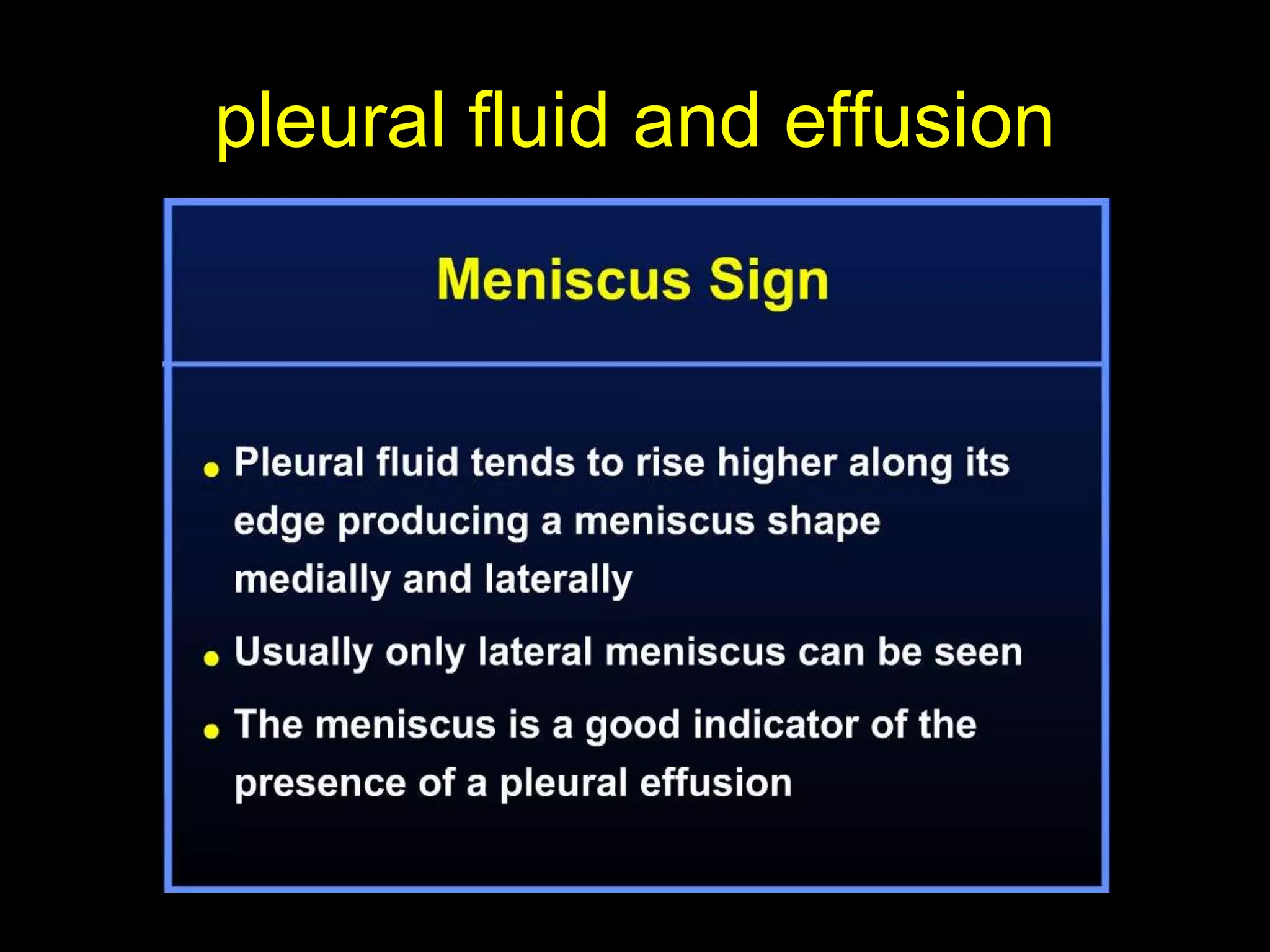 pleural fluid and effusion
 