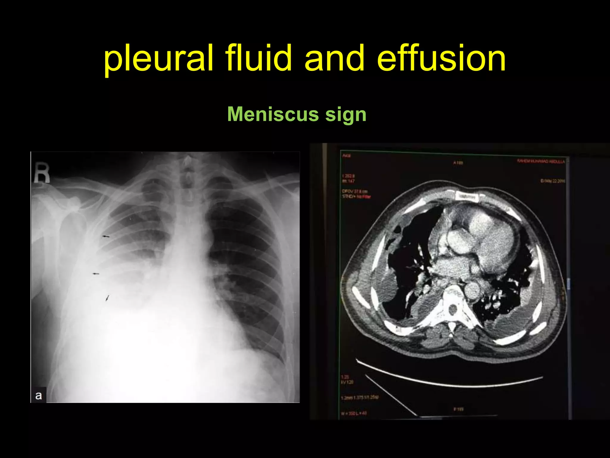 pleural fluid and effusion
Meniscus sign
 