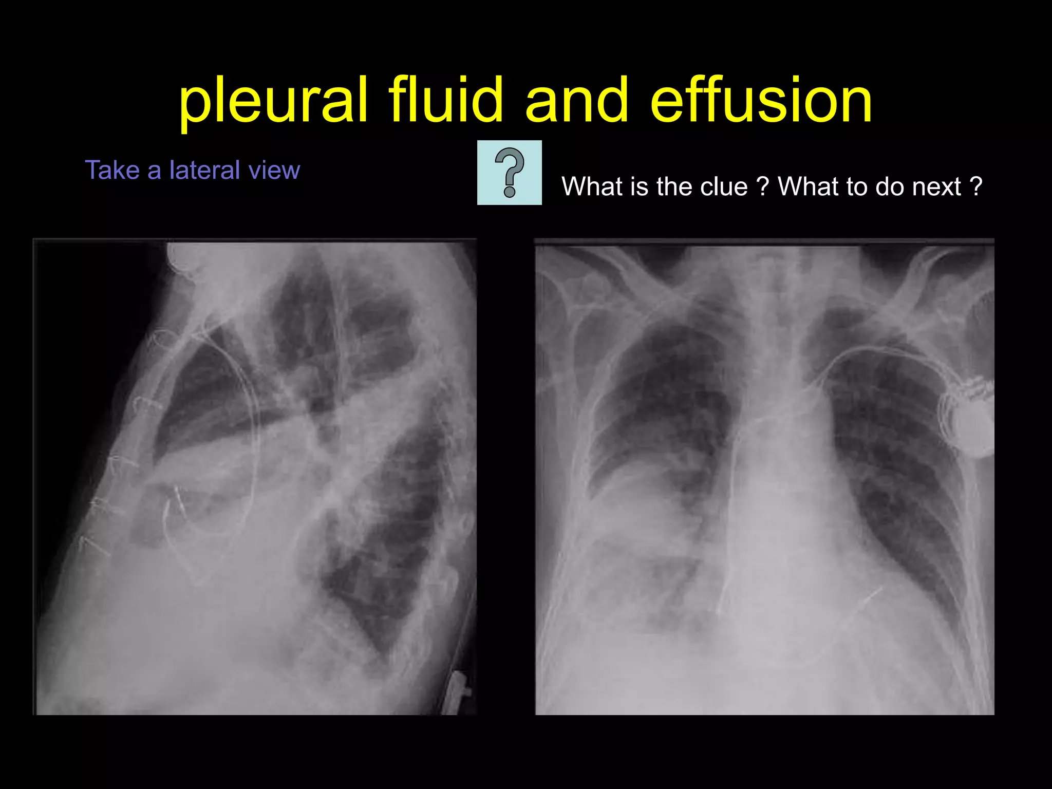 pleural fluid and effusion
• Layering effusion
• Lamellated effusion
• Loculated effusion ( vanishing
tumor )
What is the clue ? What to do next ?
Take a lateral view
 
