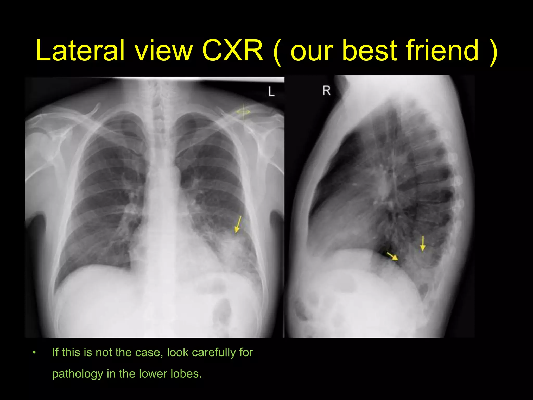 Lateral view CXR ( our best friend )
• As you go from superior to
inferior over the vertebral
bodies they should get darker,
because usually there will be
less soft tissue and more
radiolucent lung tissue (red
arrow).
• If this is not the case, look carefully for
pathology in the lower lobes.
 