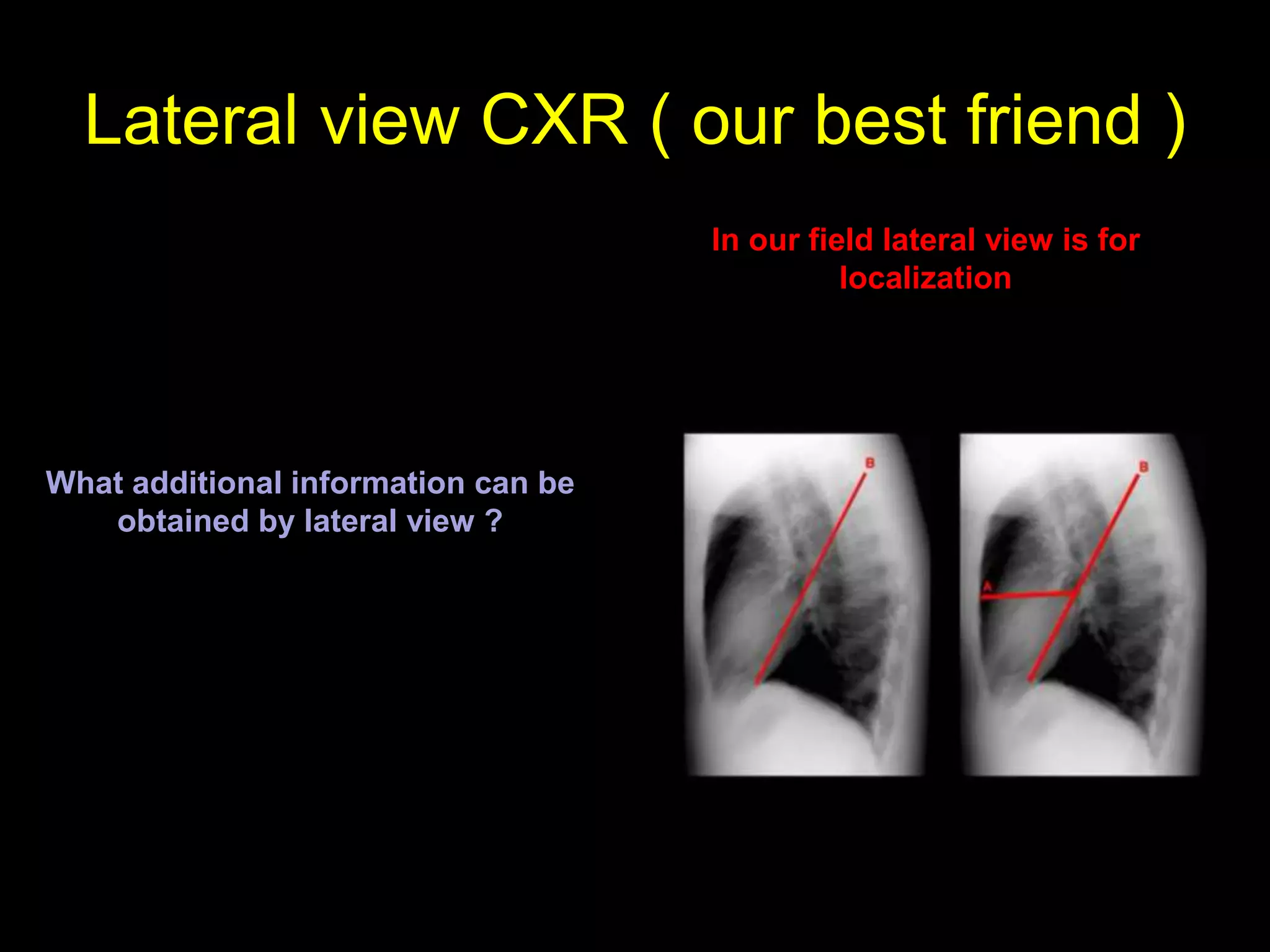 Lateral view CXR ( our best friend )
What additional information can be
obtained by lateral view ?
In our field lateral view is for
localization
 