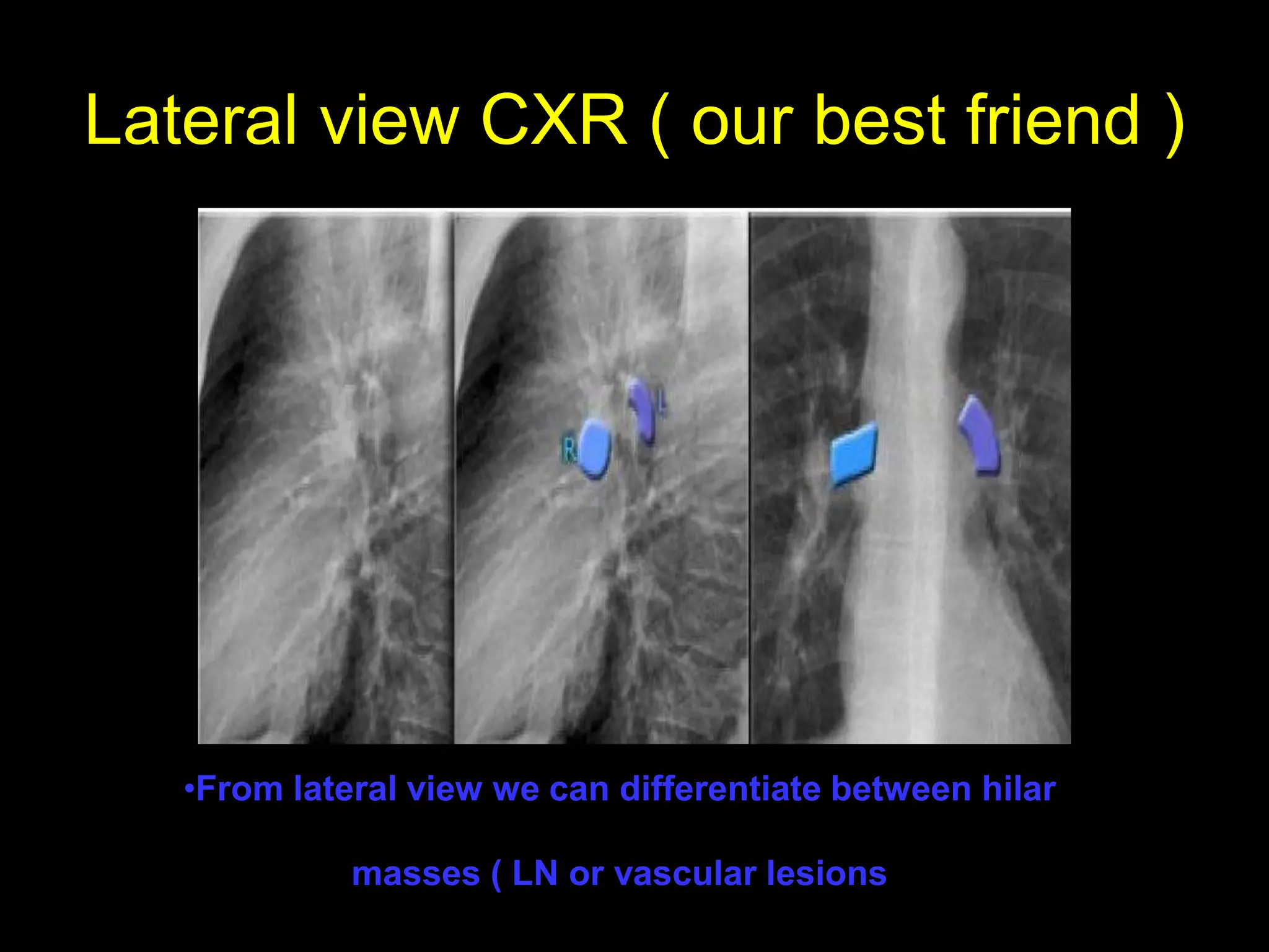 Lateral view CXR ( our best friend )
•From lateral view we can differentiate between hilar
masses ( LN or vascular lesions
 