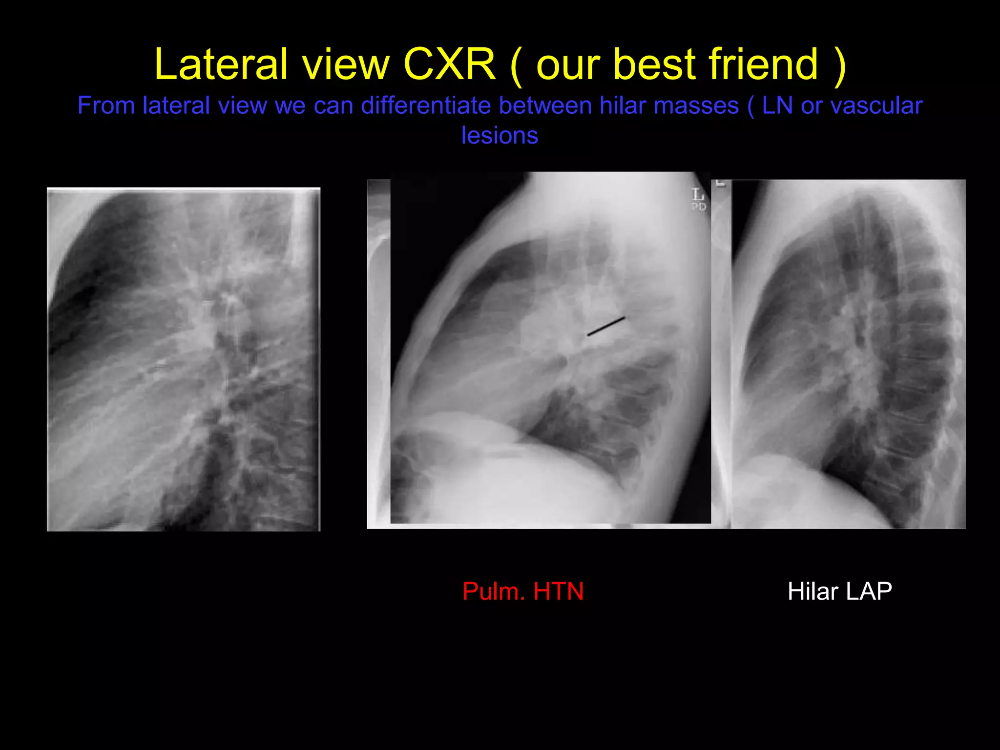 Lateral view CXR ( our best friend )
From lateral view we can differentiate between hilar masses ( LN or vascular
lesions
Hilar LAPPulm. HTN
 