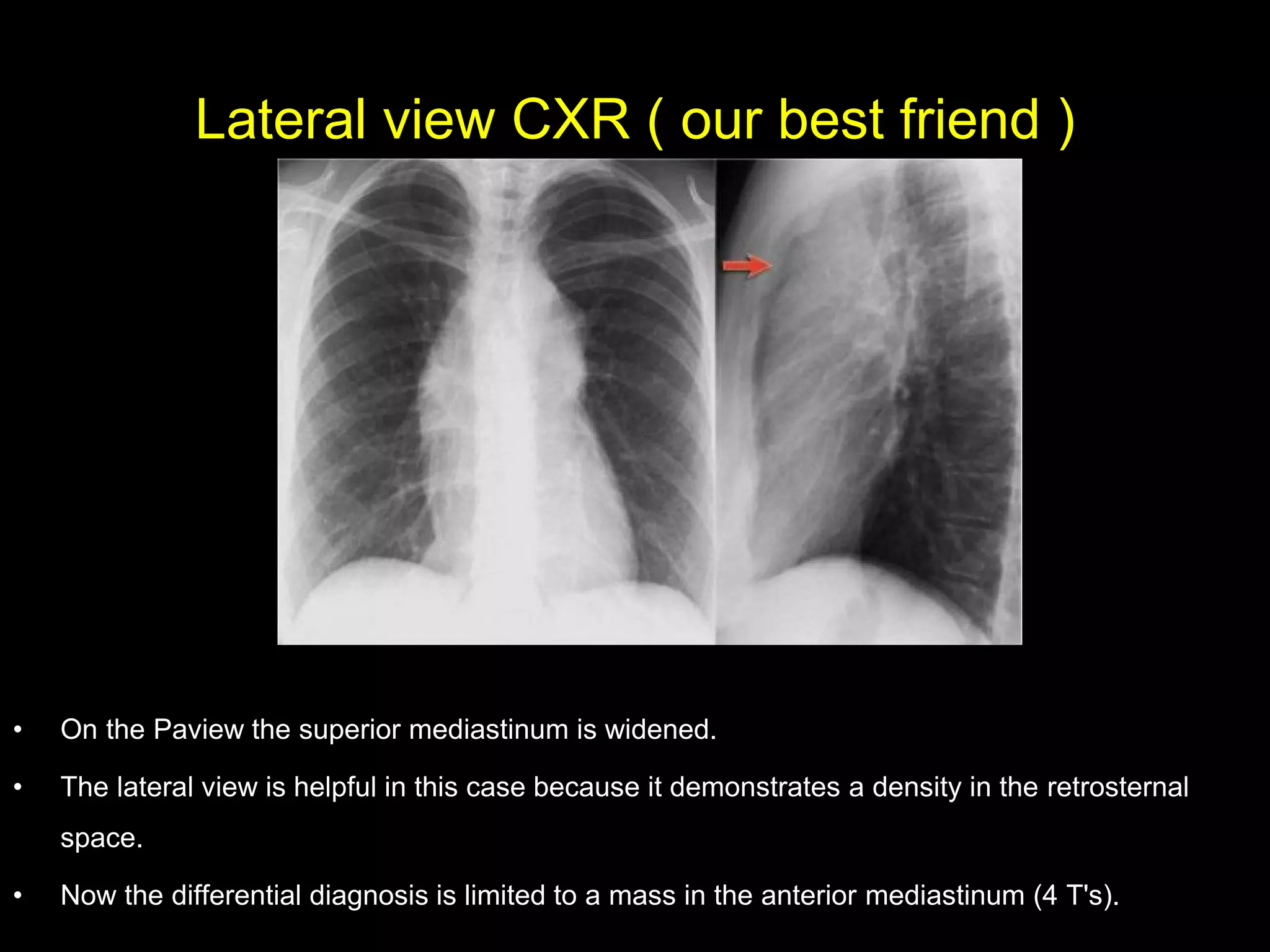 Lateral view CXR ( our best friend )
• On the Paview the superior mediastinum is widened.
• The lateral view is helpful in this case because it demonstrates a density in the retrosternal
space.
• Now the differential diagnosis is limited to a mass in the anterior mediastinum (4 T's).
 
