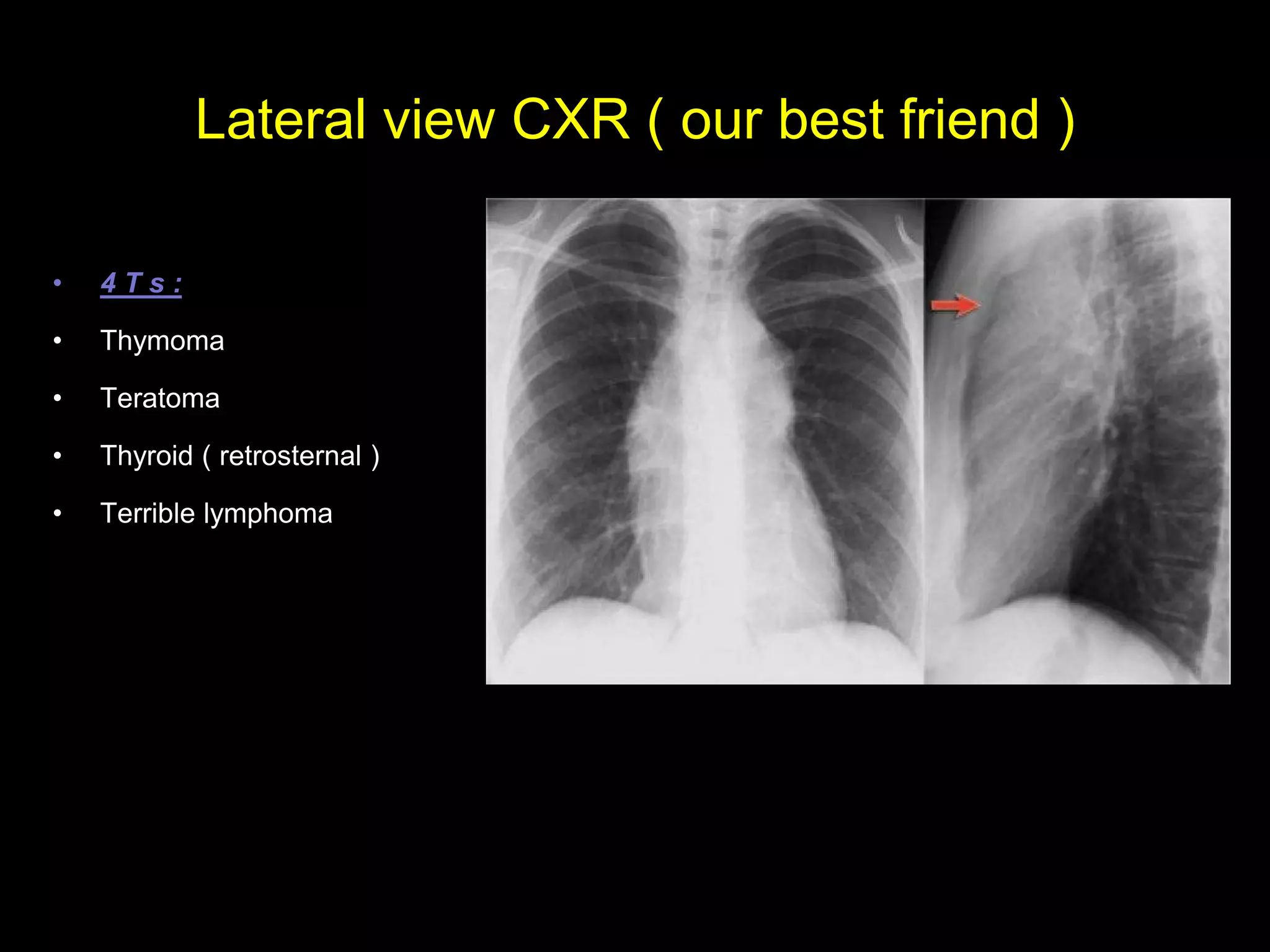 Lateral view CXR ( our best friend )
• 4 T s :
• Thymoma
• Teratoma
• Thyroid ( retrosternal )
• Terrible lymphoma
 