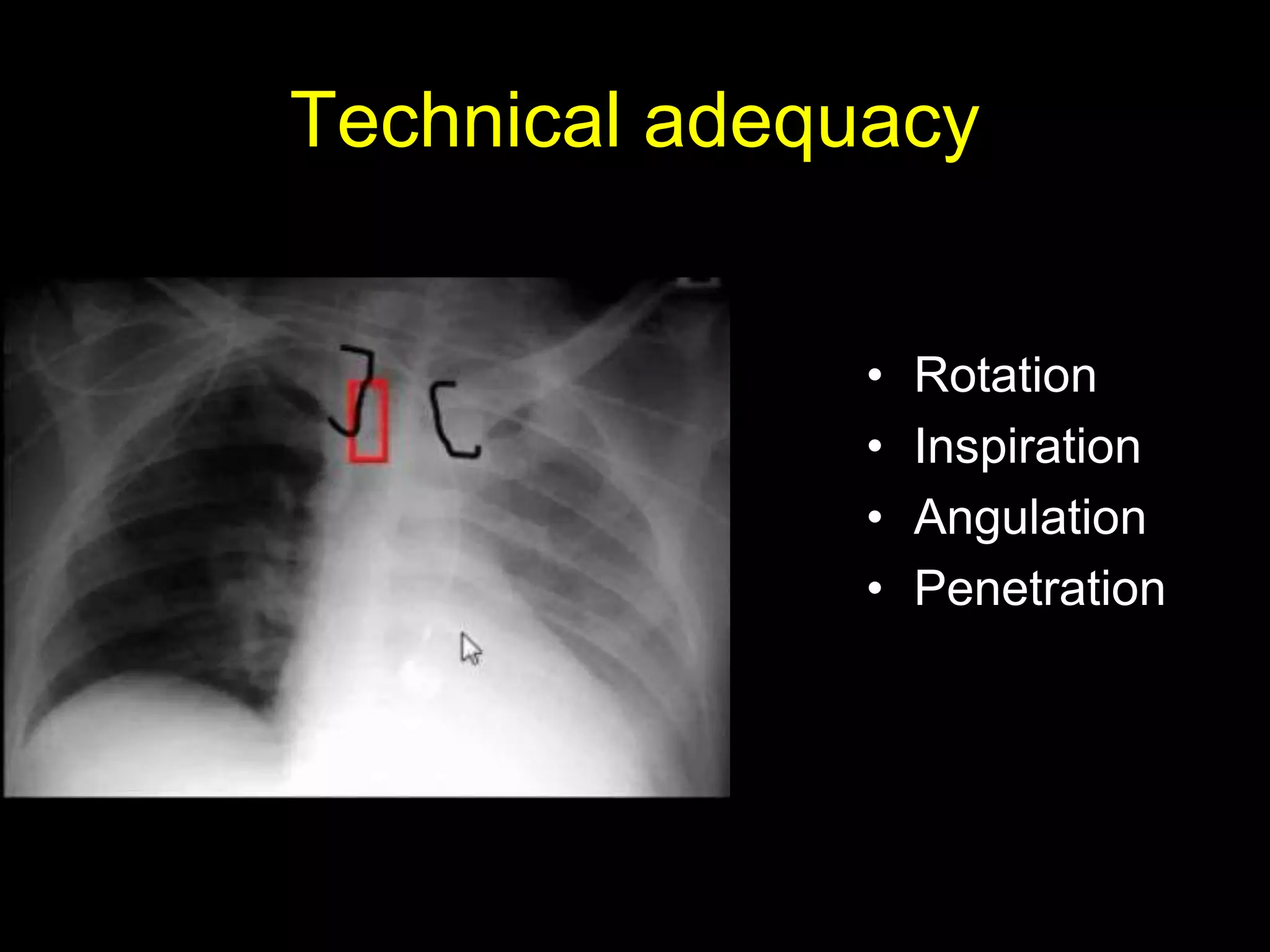 Technical adequacy
• Rotation
• Inspiration
• Angulation
• Penetration
 