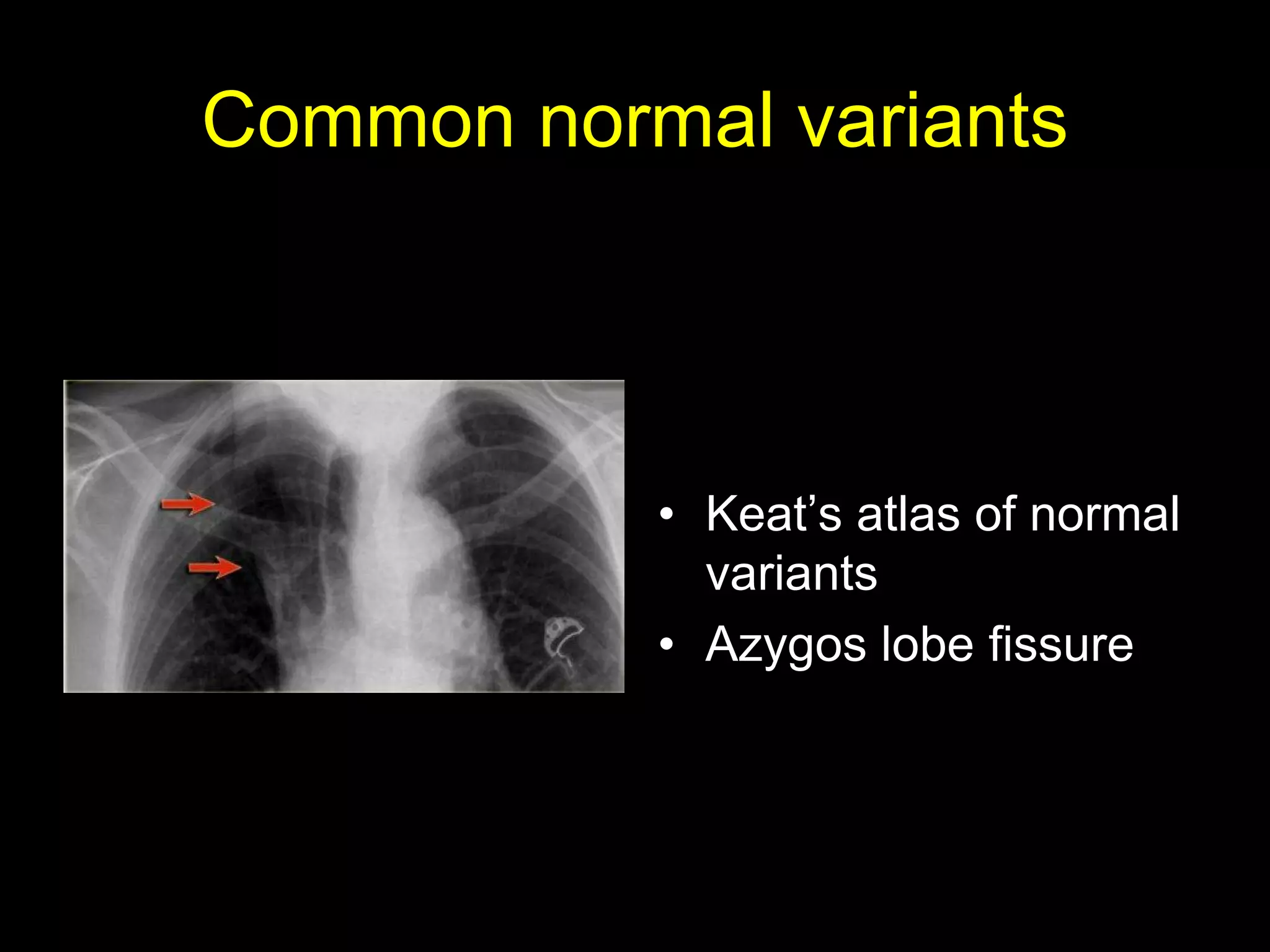 Common normal variants
• Keat’s atlas of normal
variants
• Azygos lobe fissure
 