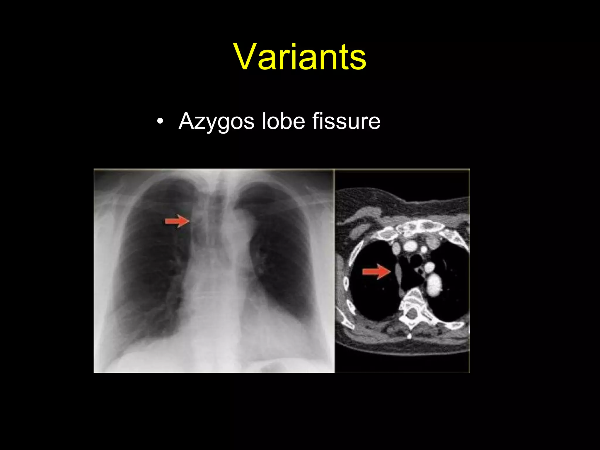 Variants
• Azygos lobe fissure
 