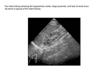 The infant kidney,showing the hyperechoic cortex, large pyramids, and lack of renal sinus fat,which is typical of the infant kidney  