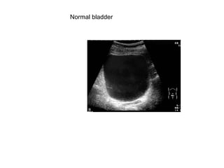 Normal bladder 