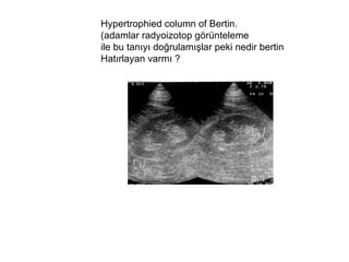 Hypertrophied column of Bertin.  (adamlar radyoizotop görünteleme  ile bu tanıyı doğrulamışlar peki nedir bertin  Hatırlayan varmı ? 
