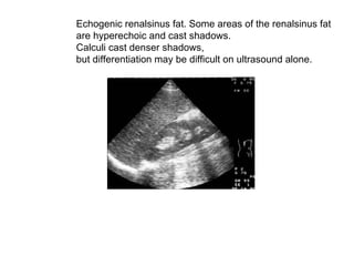 Echogenic renalsinus fat. Some areas of the renalsinus fat  are hyperechoic and cast shadows.  Calculi cast denser shadows,  but differentiation may be difficult on ultrasound alone.  