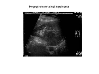 Hypoechoic renal cell carcinoma  