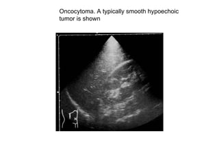 Oncocytoma. A typically smooth hypoechoic  tumor is shown  