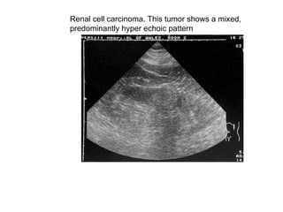 Renal cell carcinoma. This tumor shows a mixed,  predominantly hyper echoic pattern  