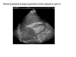 Renal lymphoma.A large hypoechoic tumor deposit is seen in  
