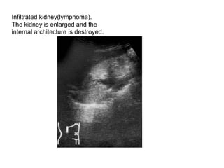 Infiltrated kidney(lymphoma).  The kidney is enlarged and the  internal architecture is destroyed.  