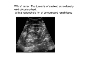Wilms’ tumor. The tumor is of a mixed echo density,  well circumscribed, with a hypoechoic rim of compressed renal tissue  