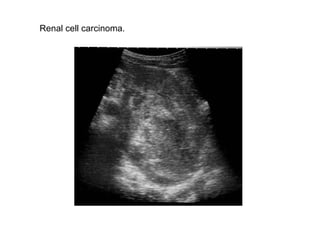 Renal cell carcinoma.  