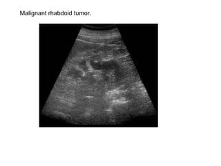 Malignant rhabdoid tumor.  