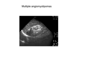 Multiple angiomyolipomas  