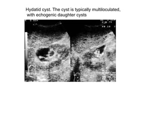 Hydatid cyst. The cyst is typically multiloculated, with echogenic daughter cysts  