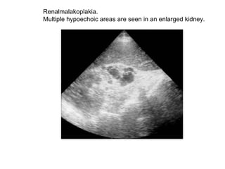 Renalmalakoplakia.  Multiple hypoechoic areas are seen in an enlarged kidney.  