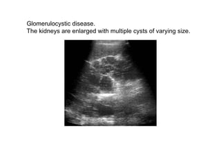 Glomerulocystic disease.  The kidneys are enlarged with multiple cysts of varying size.  