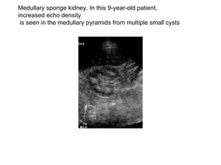 Medullary sponge kidney. In this 9-year-old patient, increased echo density is seen in the medullary pyramids from multiple small cysts  