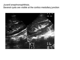 Juvenil enephronophthisis.  Several cysts are visible at the cortico medullary junction  
