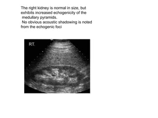 The right kidney is normal in size, but exhibits increased echogenicity of the medullary pyramids. No obvious acoustic shadowing is noted from the echogenic foci  