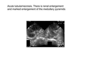 Acute tubularnecrosis. There is renal enlargement  and marked enlargement of the medullary pyramids  