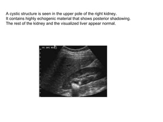 A cystic structure is seen in the upper pole of the right kidney.  It contains highly echogenic material that shows posterior shadowing.  The rest of the kidney and the visualized liver appear normal.  