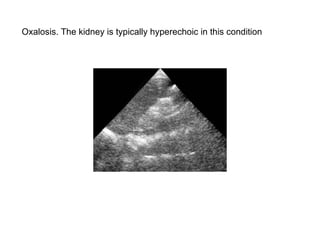 Oxalosis. The kidney is typically hyperechoic in this condition  