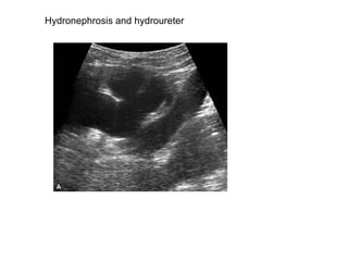Hydronephrosis and hydroureter  